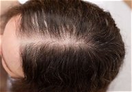 Thinning Hair